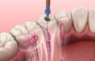 A 3D illustration of root canal treatment